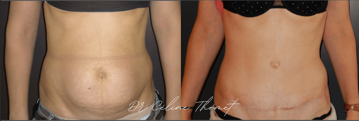 Abdominoplastie Geneve avant apres face Dr Thomet