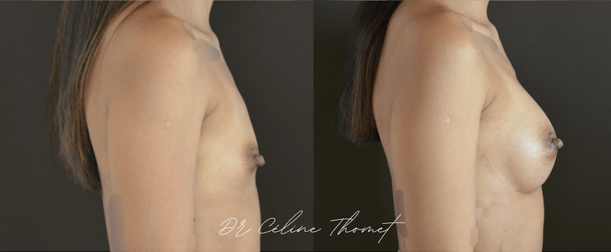Augmentation mammaire par prothèses 3 Augmentation mammaire protheses Geneve avant apres profile Dr Thomet