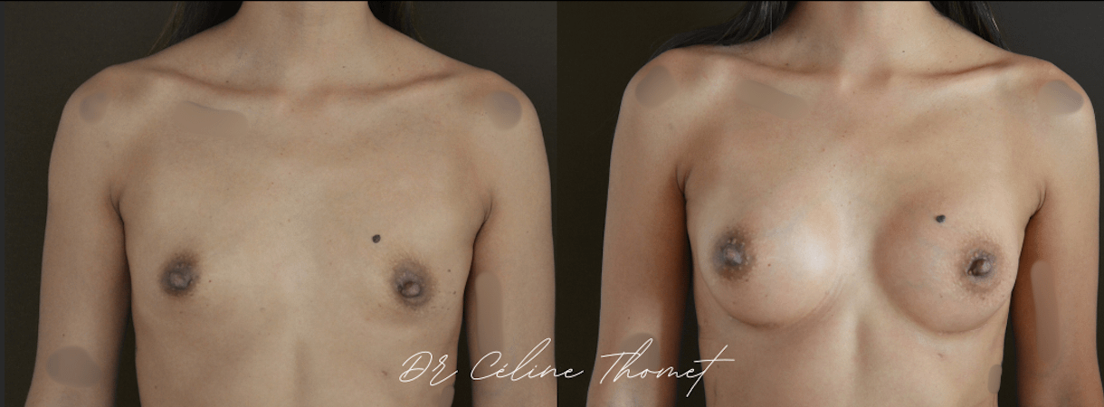 Augmentation mammaire protheses Geneve avant apres face Dr Thomet