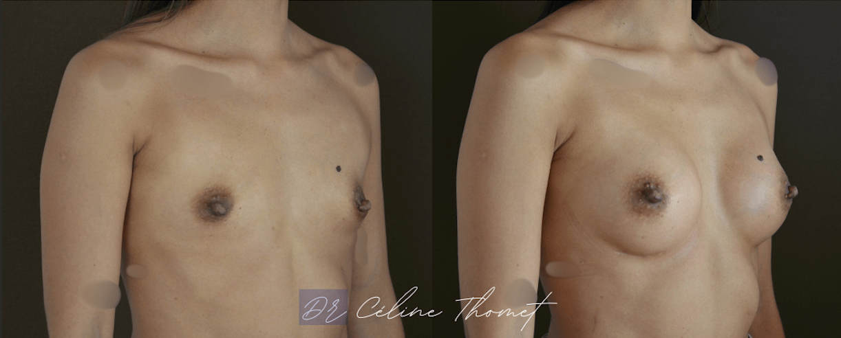 Augmentation mammaire par prothèses 2 Augmentation mammaire protheses Geneve avant apres oblique Dr Thomet