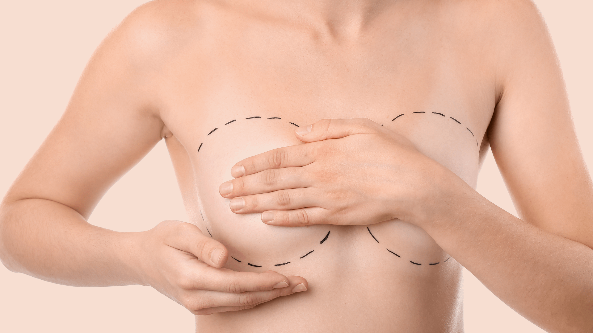 Augmentation mammaire par prothèses 4 Augmentation mammaire lipofilling Geneve Dr Thomet