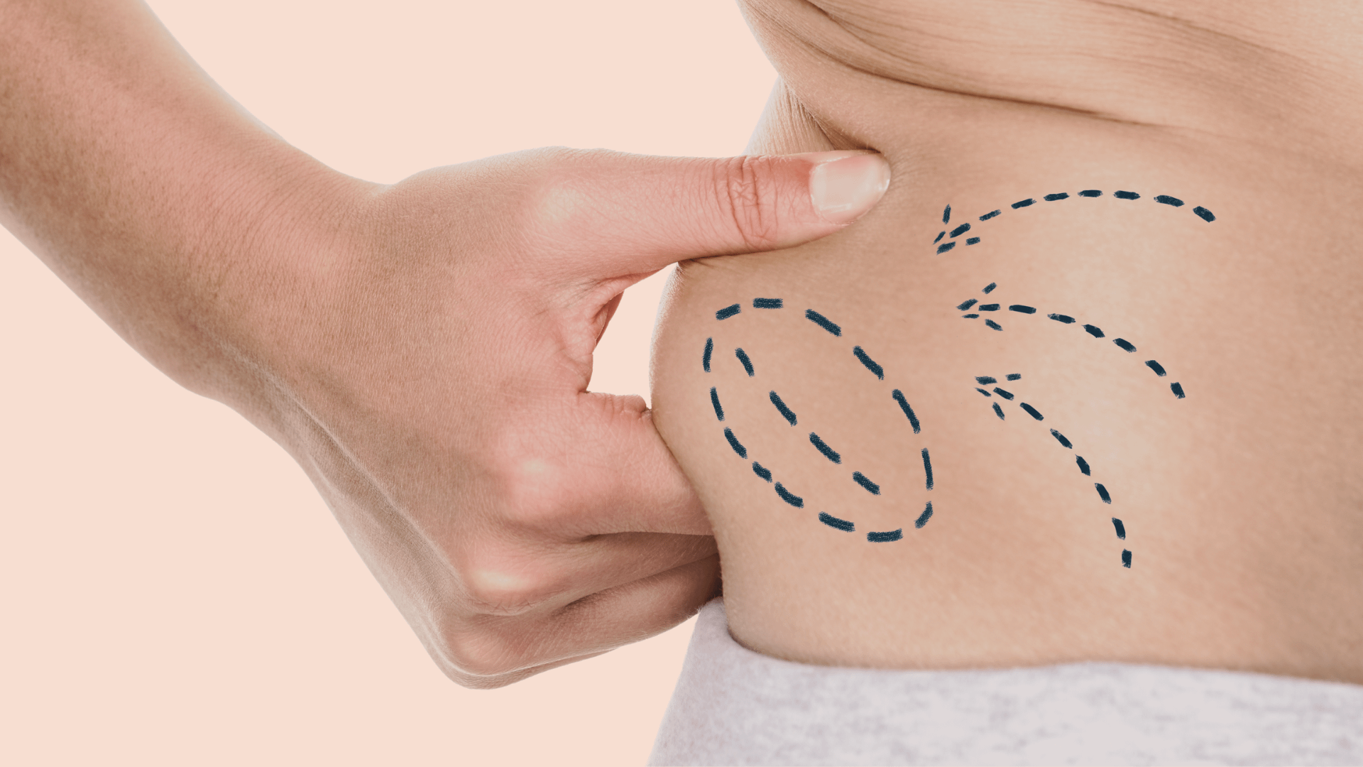 Liposuccion Geneve Dr Thomet